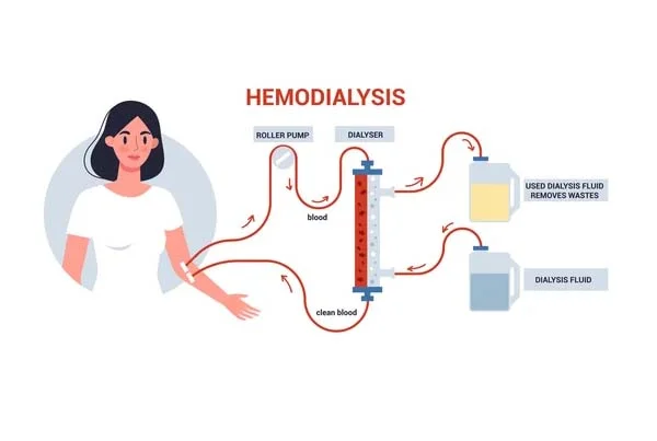 Hemodialysis
