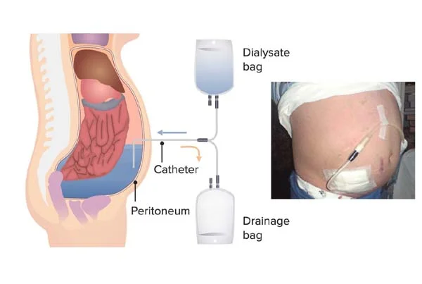 Peritoneal Dialysis